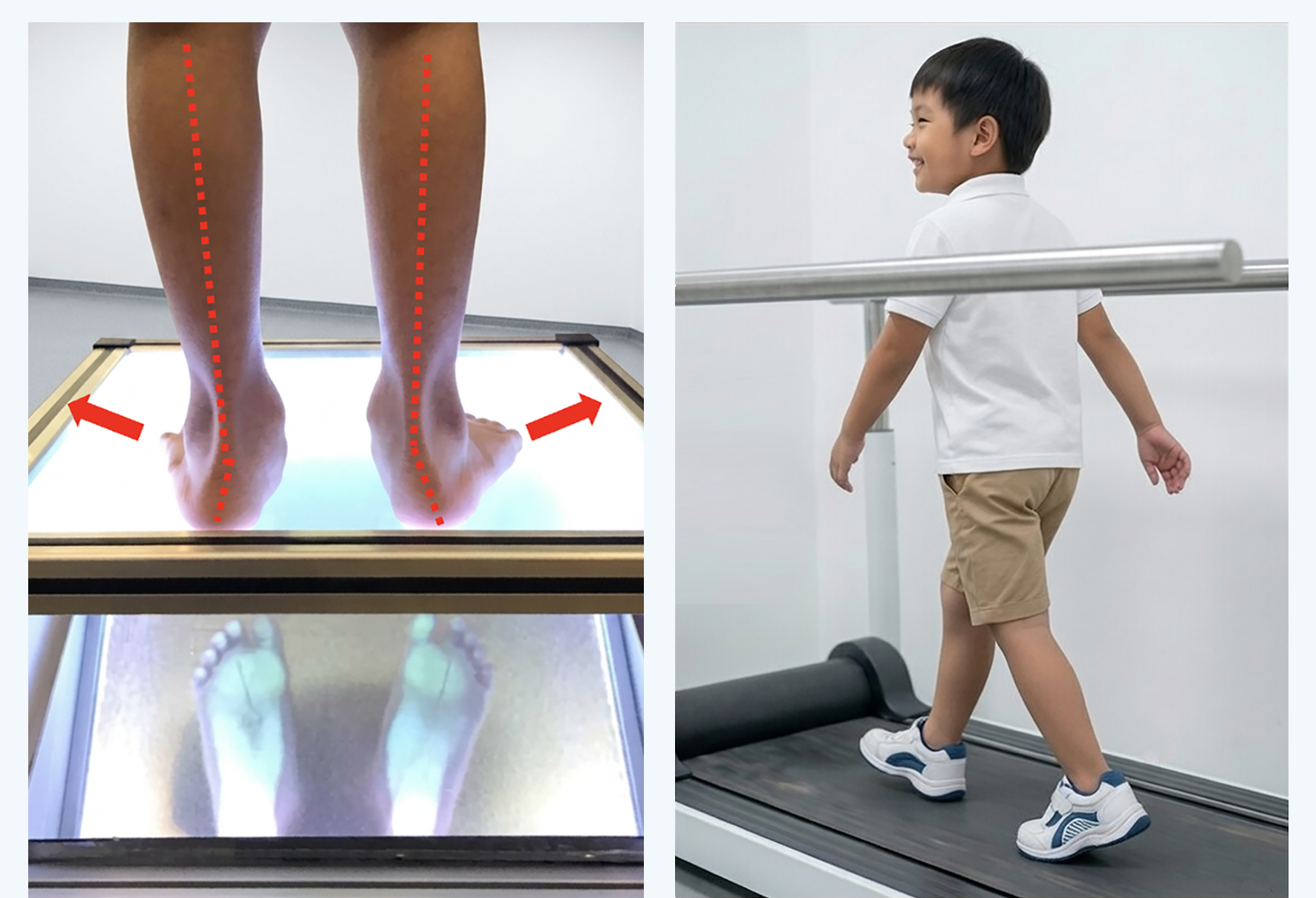 Child running: low-arch support with custom-made insoles